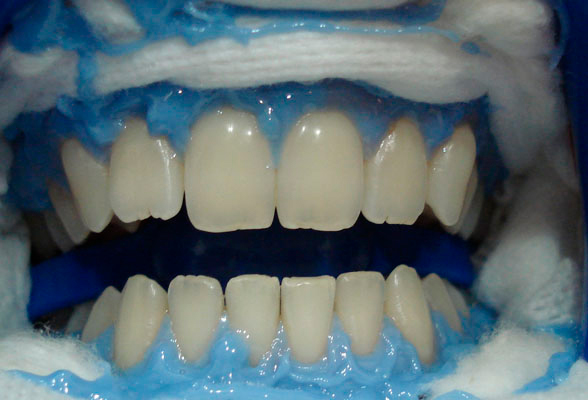 Protector gingival