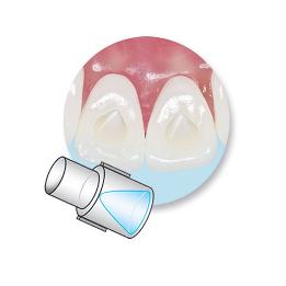 Mini-Mold para Control de Hábitos - 51395 Ortho Technology - 10 Moldes + 1 Mango.