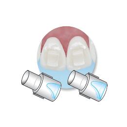 Mini Mold para Corrección Mordida de 3 mm - 51392 Ortho Technology - 10 Moldes + 1 Mango